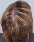 After Hair Transplant&nbsp;Hair Thinning